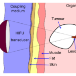 High-intensity focused ultrasound therapy market