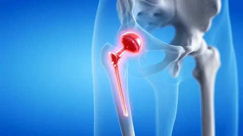 Hip Replacement