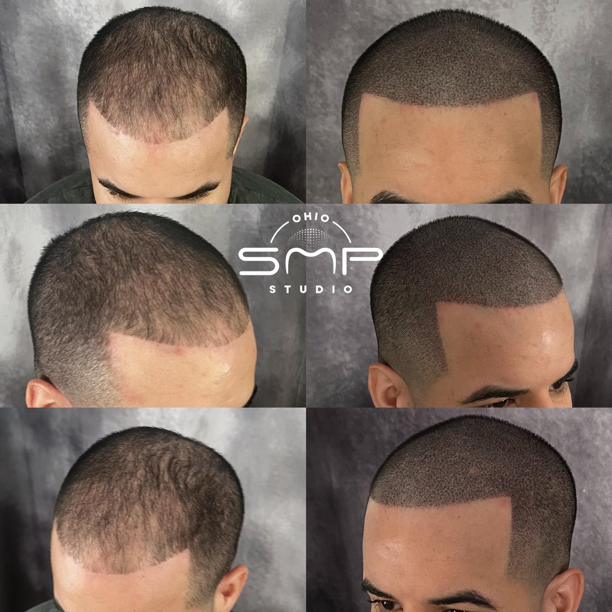 Scalp Micropigmentation: Mansfield’s Leading Hair Restoration Solution